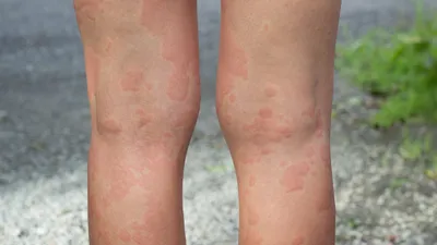 Аллергия на холод: что это и как с ней справиться - статья на МЦ «ЛОТОС»