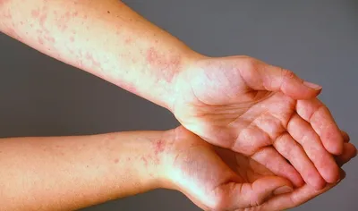 Вплоть до лихорадки: Врач Бережанский рассказал о проявлениях аллергии на  холод