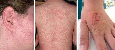 Аллергия на солнце: излечима не всегда и возникает в любом возрасте - Все  про аллергию
