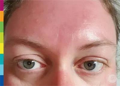 Дерматолог объяснила, как проявляется аллергия на солнце – Москва 24,  02.08.2023