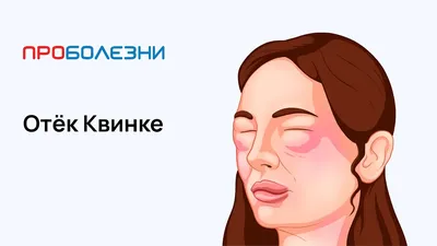 Крапивница - Доказательная медицина для всех