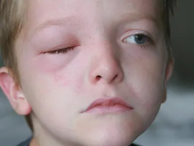 Ангионевротический отек век — аллергический отек Квинке у ребенка. Как  снять аллергический отек глаз