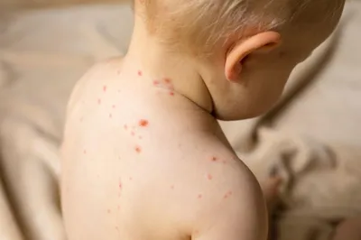 Реакция на прививку от кори?! — 20 ответов | форум Babyblog