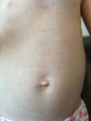 Здоровье всей семьи с институтом им. Габричевского - Как правило, если у  ребенка появляется сыпь на теле, то первая возникающая у мамы мысль: « аллергия». А все ли сыпи у ребенка носят аллергический
