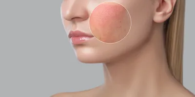 Причины сыпи на лице | Pro-климакс | Дзен
