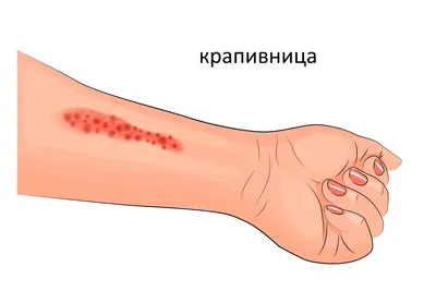 Крапивница - причины, симптомы, лечение - Медицинский центр в Москве