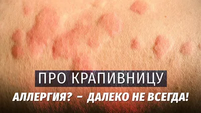 Лечение крапивницы | Асмедия | Санкт-Петербург (СПб)
