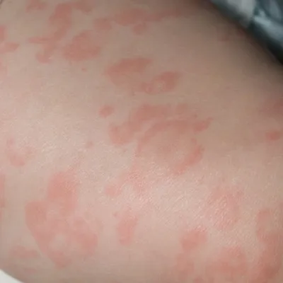Аллергия на холод и на жару: симптомы этой крапивницы и методы лечения