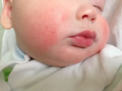 Аллергия у ребенка. Лечение - Центр европейской дерматологии