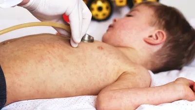 Кожный зуд у ребенка при атопическом дерматите: причины, лечение |  atopicbaby.ru