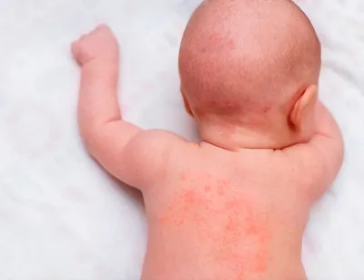 Помогите! Аллергия (крапивница) у ребёнка. Пищевая или на стиральный  порошок Ушастый нянь? — 20 ответов | форум Babyblog