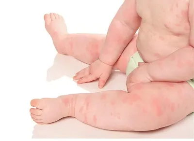 Контактный аллергический дерматит у детей - Ева Арт