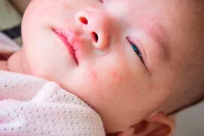 Сыпь у ребенка: виды, причины появления, температура, лечение, отзывы врачей