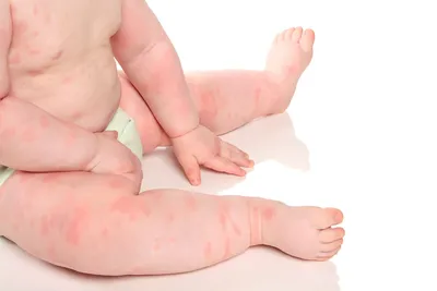 Как выглядит пищевая аллергия у новорожденных