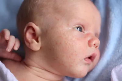 Аллергия у новорожденных: причины, симптомы, лечение
