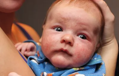 Сыпь на лице у новорожденного: причины появления сыпи на лице, голове и  шее, возможное лечение
