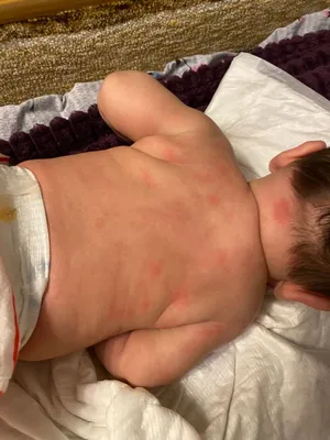 Сыпь у новорожденного на лице и шее - YouTube