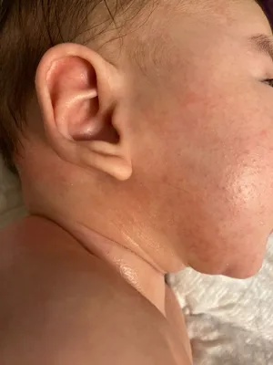 аллергия на кожу на щеке новорожденного макро фото. диез на лице младенца  Стоковое Изображение - изображение насчитывающей немного, конец: 230802303