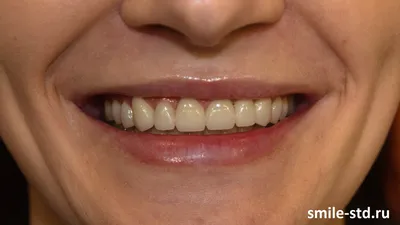 Как виниры исправили асимметрию улыбки у девушки – клиника Smile STD, Москва