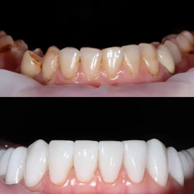 Красивые виниры на 10 верхних зубов - галерея лечения пациентка Елизавета