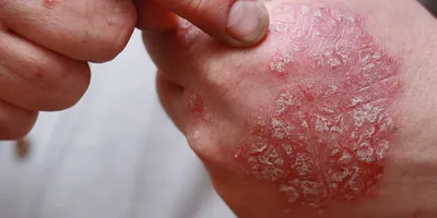 Сыпь на коже, на теле — Derma.ua