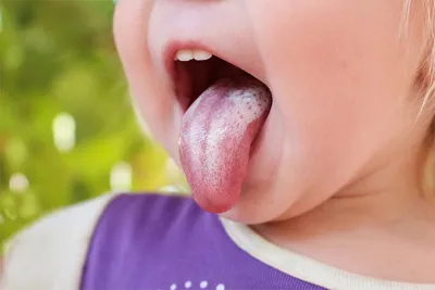 Стоматит: лекарства для взрослых и детей — симптомы и причины появления на  языке, губах и деснах, средства для лечения