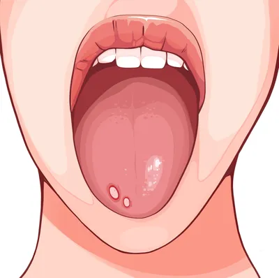 Кандидоз полости рта: как лечить молочницу во рту, симптомы, причины