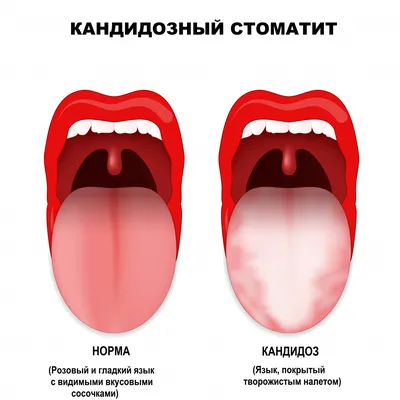 У каждого пятого – сыпь на языке: новый симптом коронавируса