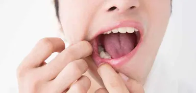 Белый налет на языке - что это значит и как от него избавиться? | Полезные  советы - блог стоматологической клиники Complex Dent в Киеве