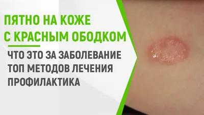 Не ясной этиологии красные пятна — 3 ответов | форум Babyblog