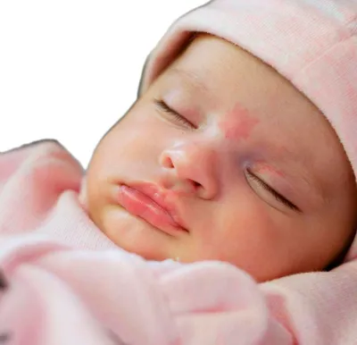 Красное пятно на лбу у новорожденного фото фото