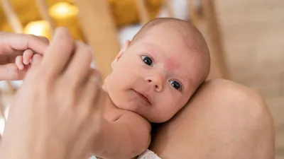 Родимые пятна у новорожденных: когда следует бить тревогу?