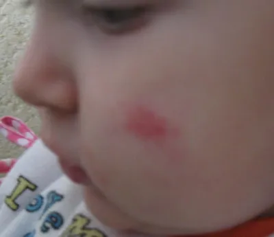 Красные щеки у ребенка – признак здоровья или аллергической реакции? |  Новости | As Clinic | Клиника красоты и здоровья в Астане