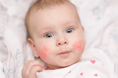 Красные пятнышки на лице у новорожденного: вероятные причины, особенности и  виды