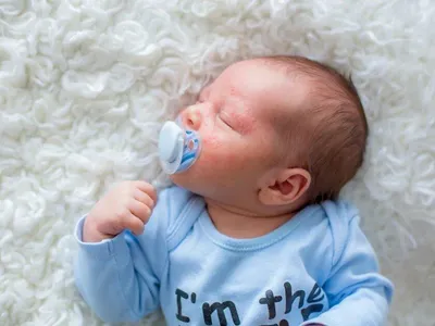 Сыпи у новорожденных | блог клиники Наше Время