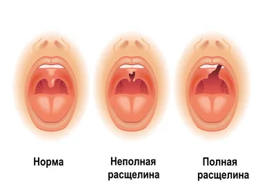 ПРОЯВЛЕНИЯ ВИЧ В ПОЛОСТИ РТА