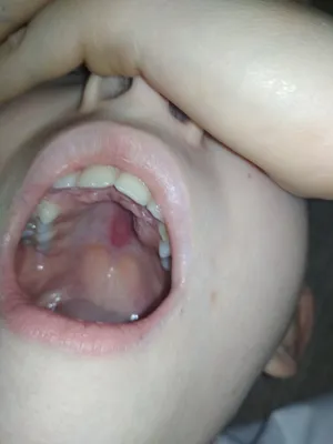Растет вторым рядом зуб и красное пятно на небе - Вопрос стоматологу - 03  Онлайн