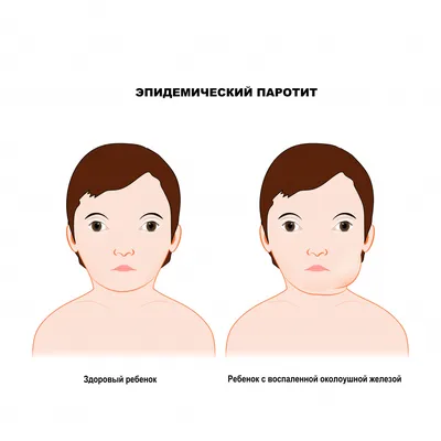 Корь - Педиатрия - Справочник MSD Профессиональная версия