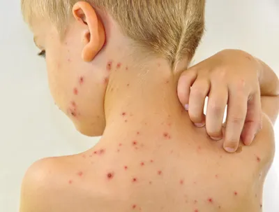 Сыпь на спине: причины, симптомы, лечение | Аллергия на спине