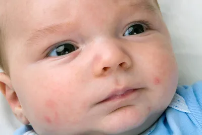 Причины появления высыпаний на затылке и теле у новорожденного - di-kids.ru