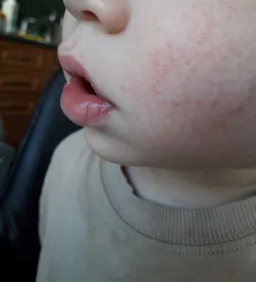 Сыпь на лице у ребенка: причины, все виды высыпаний с фото и методы лечения