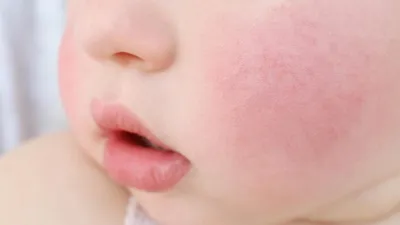 Сыпь у ребенка: что это может означать и к кому обращаться