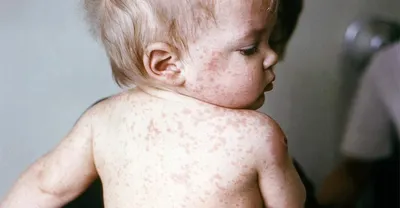 Нужна ли вакцинация от краснухи, если ее почти уже и нет? | Пикабу