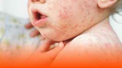 Врожденная краснуха: не просто детская инфекция