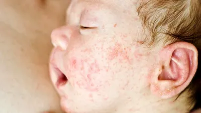 Аллергия на коже у детей: причины, симптомы и лечение в Москве
