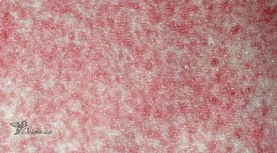 Краснуха занимает ведущее место по риску развития внутриутробных инфекций и  врожденных пороков