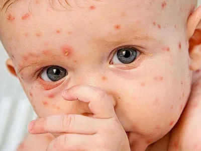 Прививка от кори, краснухи и паротита детям в Краснодаре, сделать в клинике  Kids-Med
