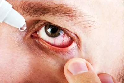 Кровоизлияние в глазу: причины появления и лечение