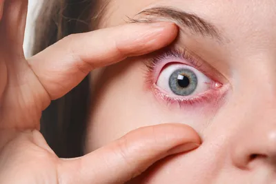 Покраснение глаз — может быть симптомом COVID-19, но нечасто | Клиника  Рассвет