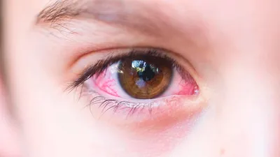 Красные глаза: причина, что делать